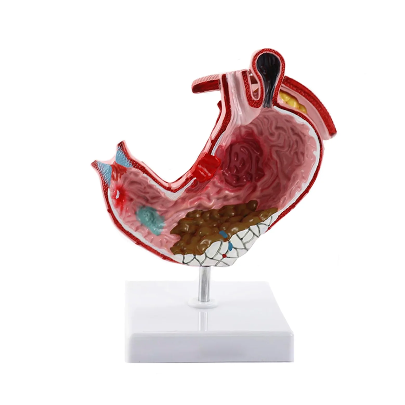 Humano EN Anatomía estomacal patológica Modelo de demostración del estómago Ayuda médica SIDA