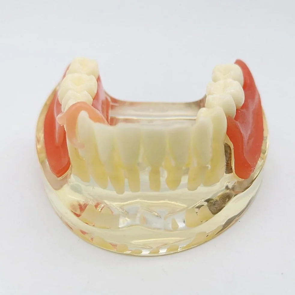 Implant-Supported Restorations Comparison Model Transparent Dental Implant Model Education Study