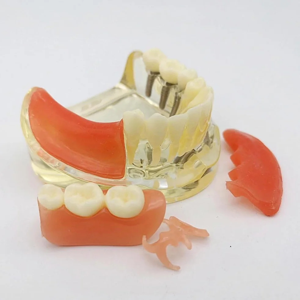 Implant-Supported Restorations Comparison Model Transparent Dental Implant Model Education Study