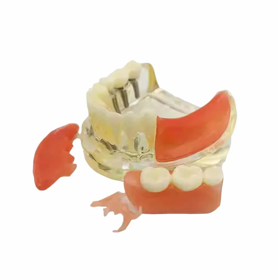 Implant-Supported Restorations Comparison Model Transparent Dental Implant Model Education Study