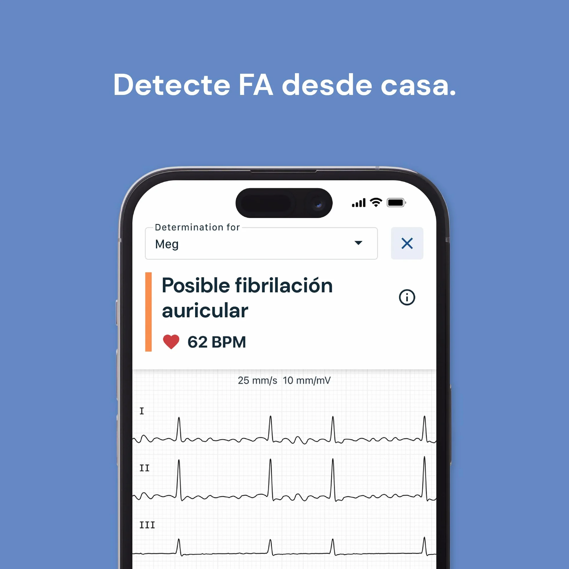 Kardiamobile Electrocardiografo Portatil de 6 derivaciones – Detecta fibrilación Auricular – Resultados instantáneos en 30 Segundos – Funciona con la mayoría de los Smartphones