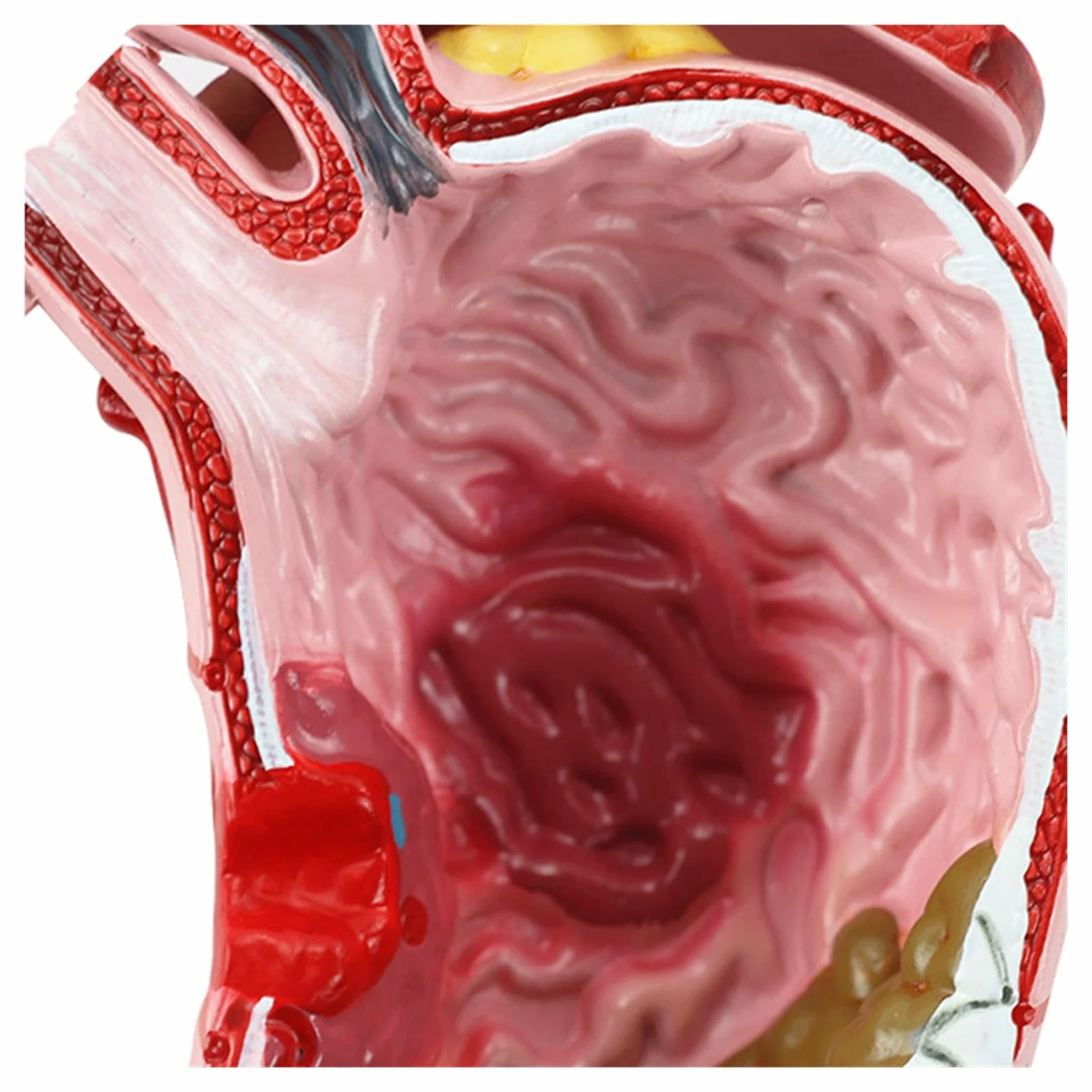 Humano EN Anatomía estomacal patológica Modelo de demostración del estómago Ayuda médica SIDA