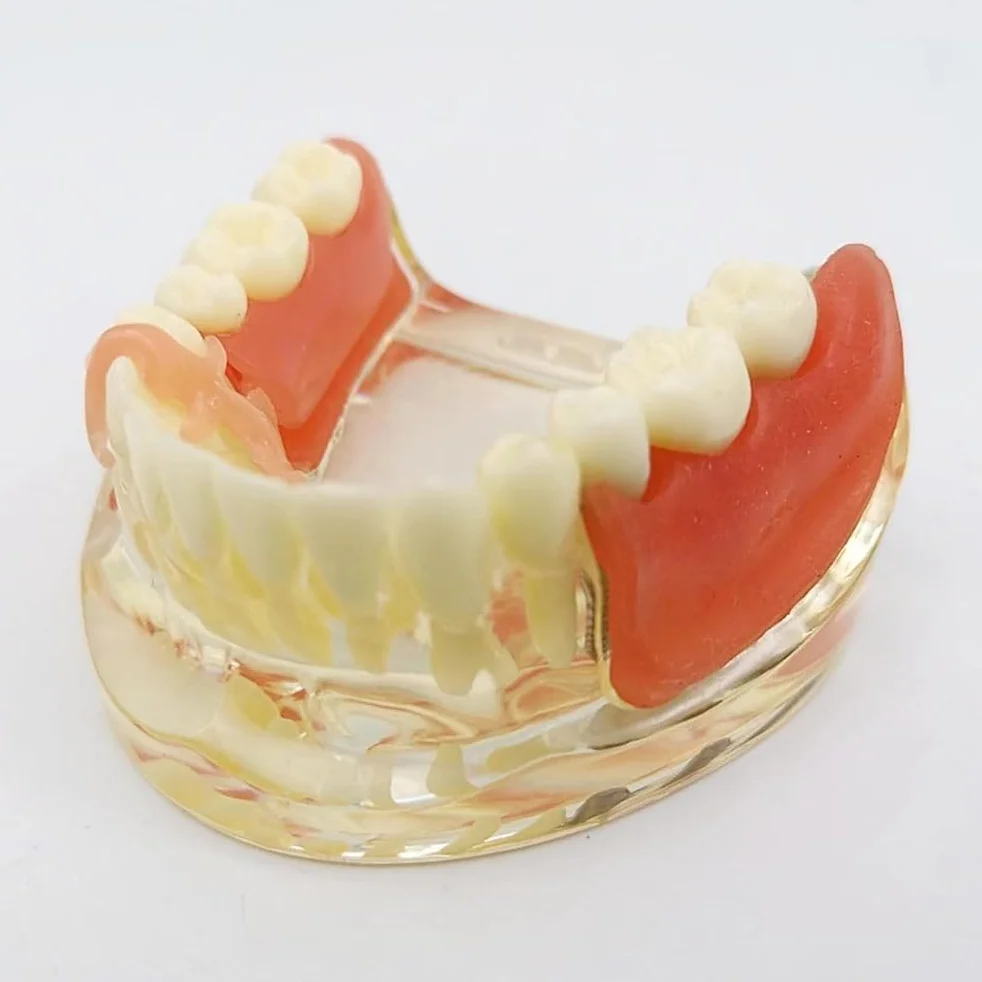 Implant-Supported Restorations Comparison Model Transparent Dental Implant Model Education Study